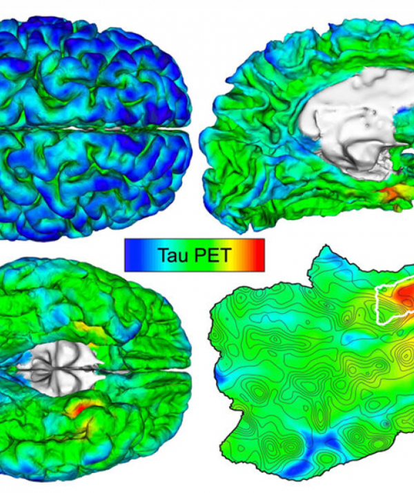 Văn học Phật giáo - Làm sao tránh bệnh lẩn - Alzheimer